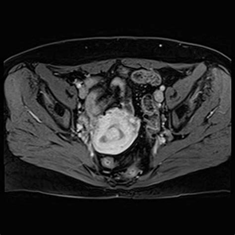 polypoid endometriosis mri